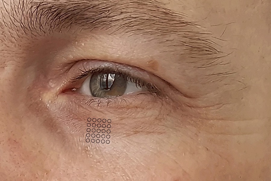Under eye wrinkles and fine lines before treatment