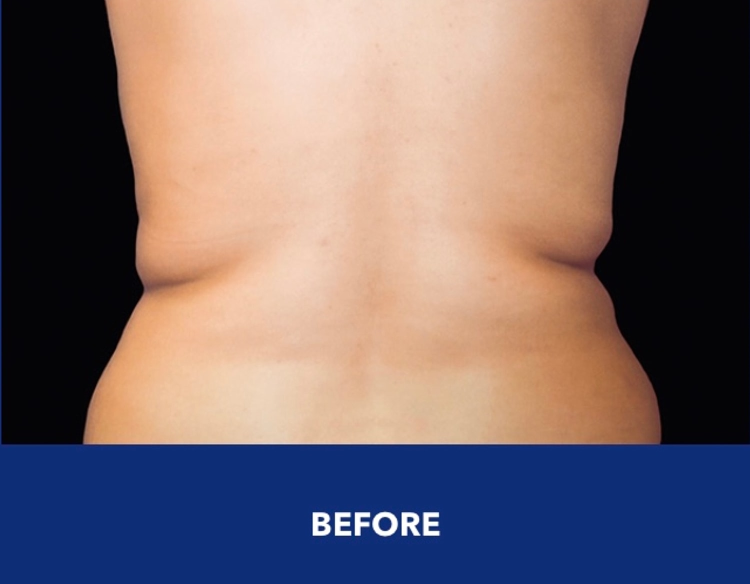 Back fat before CoolSculpting treatment showing side bulges