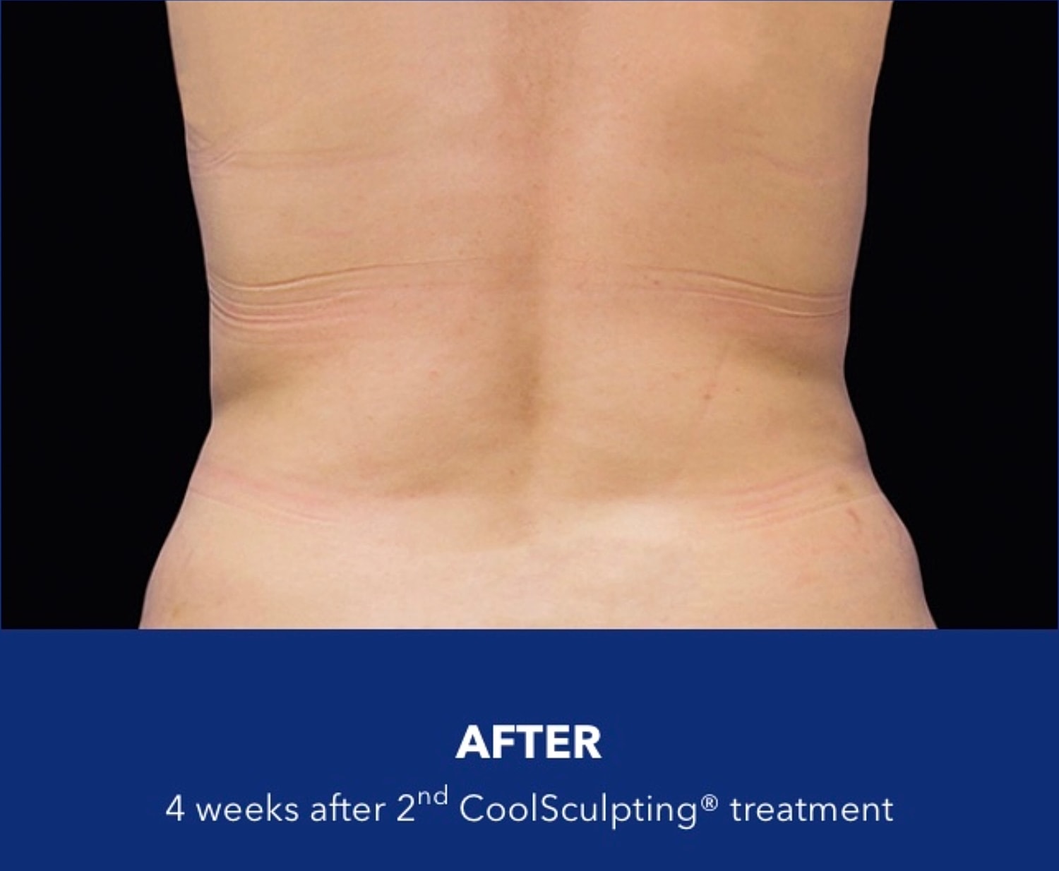 Back fat reduction after CoolSculpting showing improved contour after 4 weeks