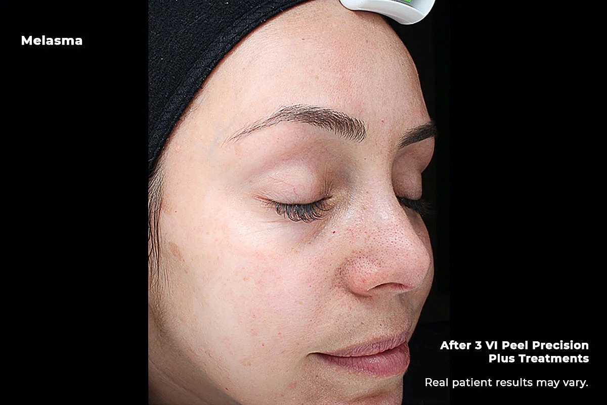 Melasma and uneven pigmentation improvement after VI Peel treatment Dedham MA