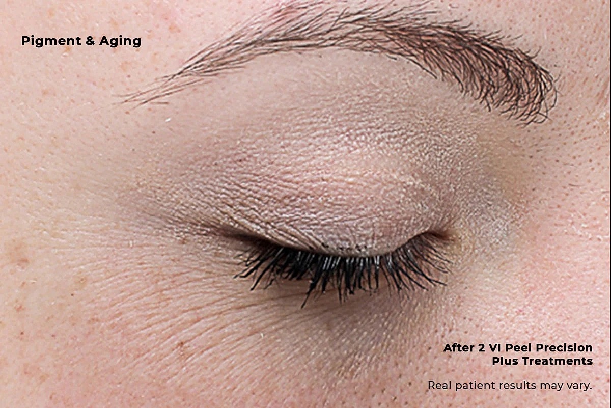 Reduced pigmentation and smoother under-eye skin after VI Peel treatment Dedham MA