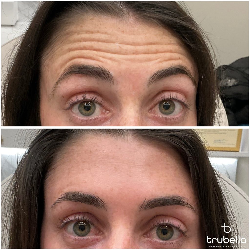 Before-and-after comparison of a patient treated with Botox at Trubella MedSpa & Aesthetics in Dedham, MA. The image demonstrates the improvement in dynamic forehead lines after treatment while maintaining a natural appearance. Results vary by patient and treatment plan, and all Botox treatments are performed under physician-led medical oversight.